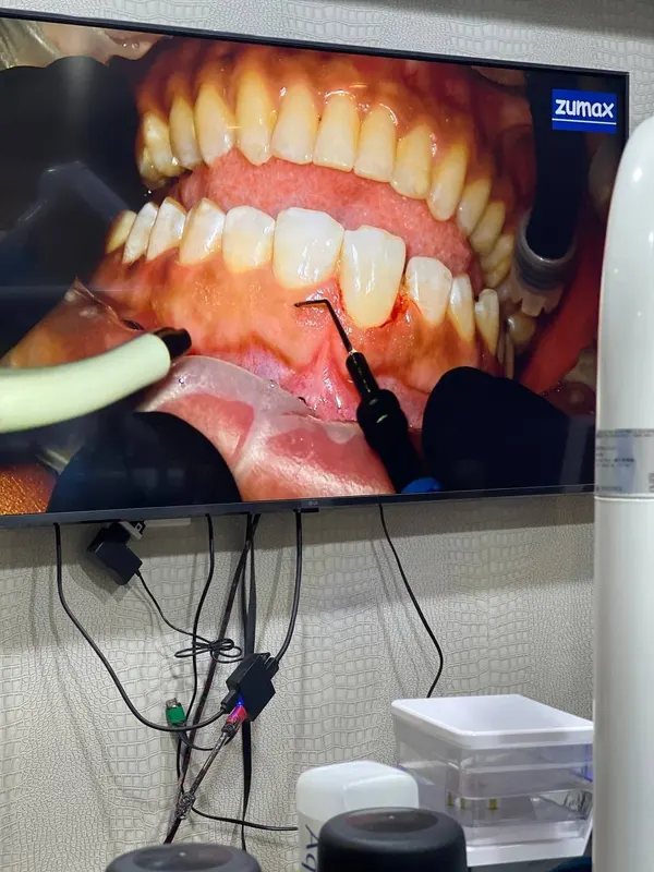 Crown Lengthening course