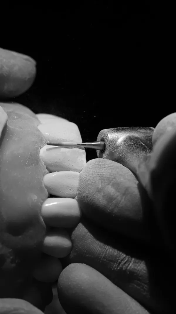 Anterior & posterior composite