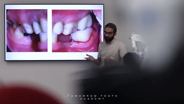 Crown Lengthening course