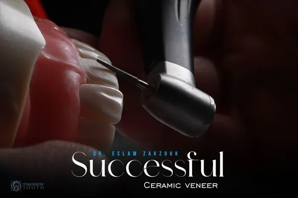Successful ceramic veneers