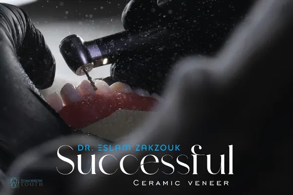 Successful ceramic veneers