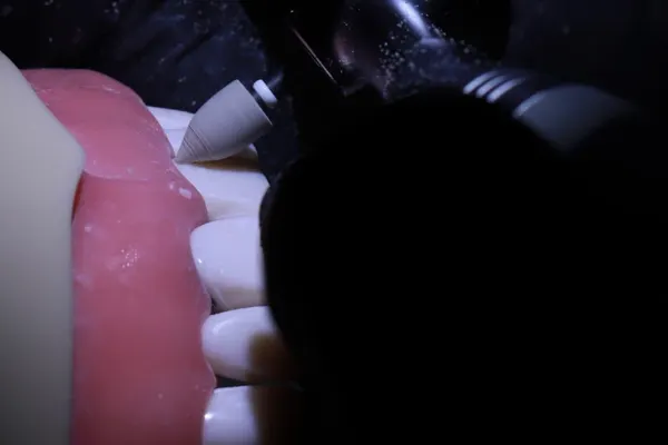 Successful ceramic veneers