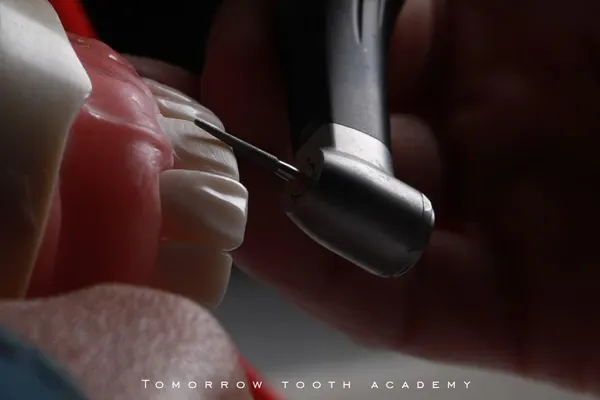 Successful ceramic veneers