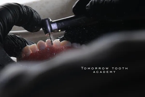 Successful ceramic veneers