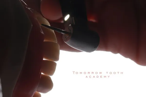 Successful ceramic veneers