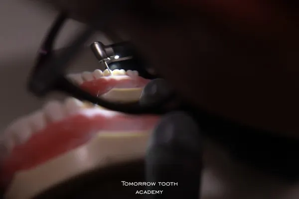 Successful ceramic veneers